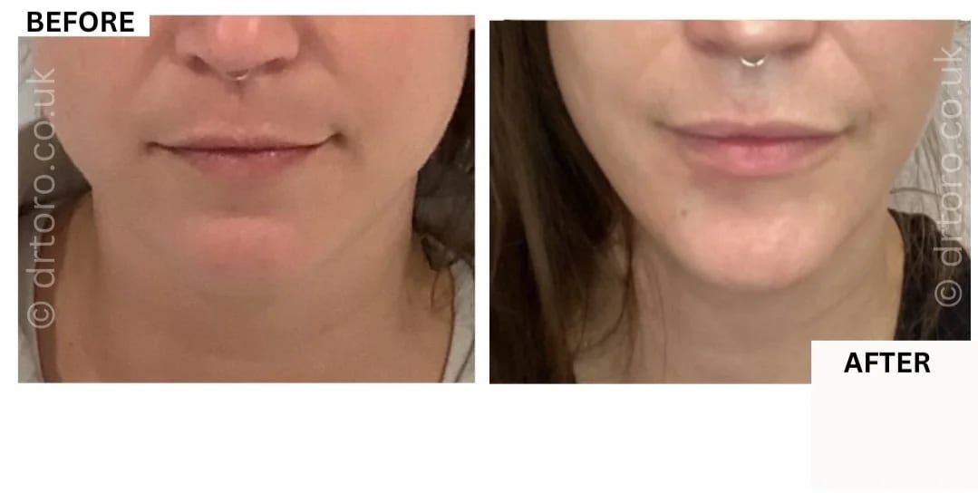 Before and after masseter treatment for bruxism, slimming the jawline