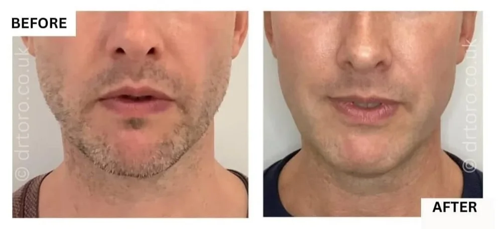 Before and after cheek filler, lifting downturned mouth corners