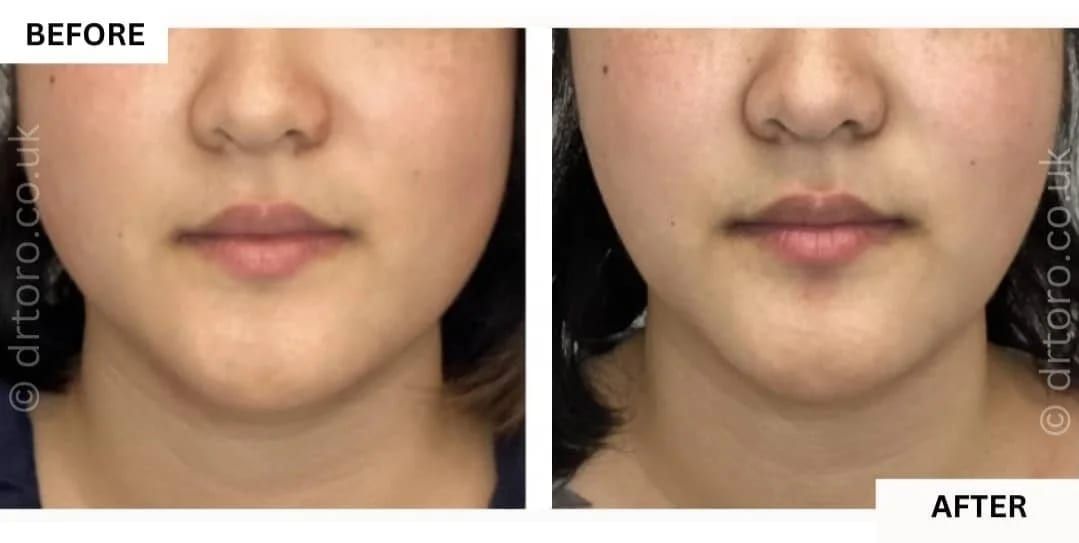 Before and after jawline slimming with anti-wrinkle treatment