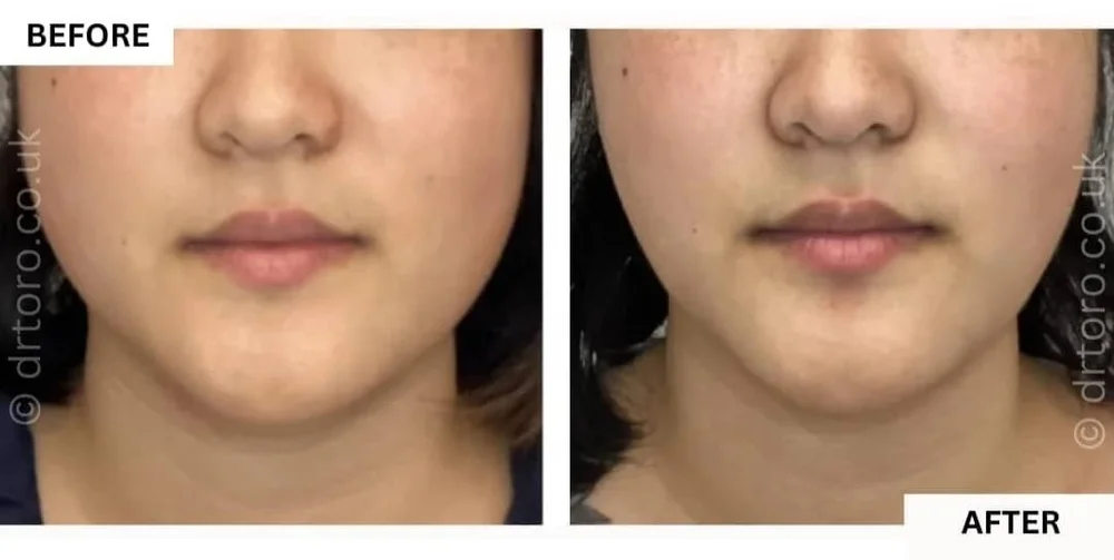Before and after jawline slimming with anti-wrinkle treatment