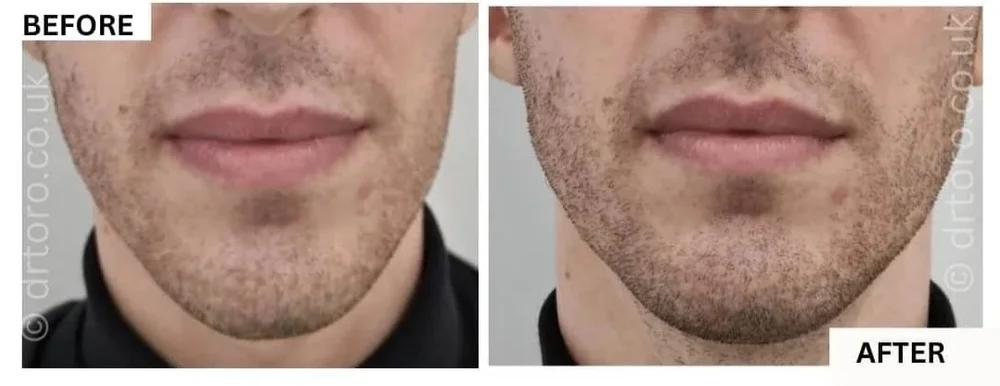 Before and after jawline widening with dermal filler