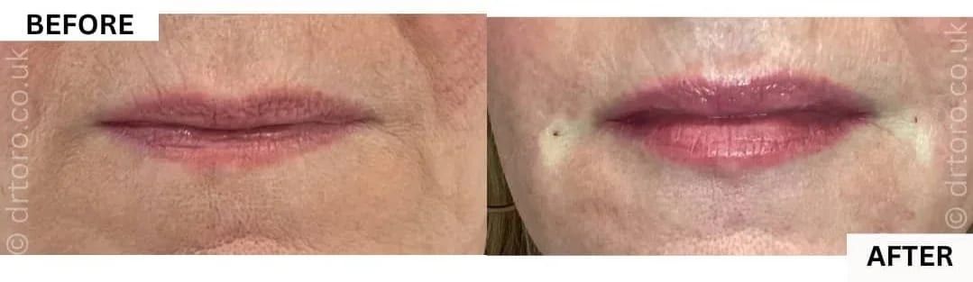 Before and after natural-looking lip filler on mature lips