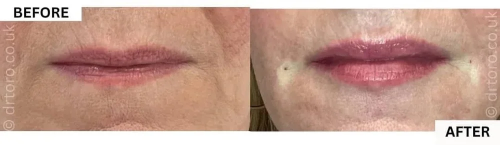 Before and after natural-looking lip filler on mature lips