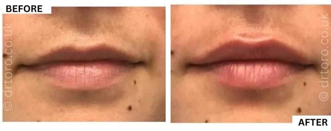 Before and after natural-looking lip filler