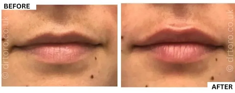 Before and after natural-looking lip filler