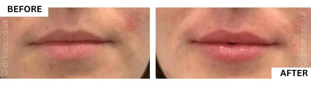 Before and after lip treatment focused on hydration with minimal added volume