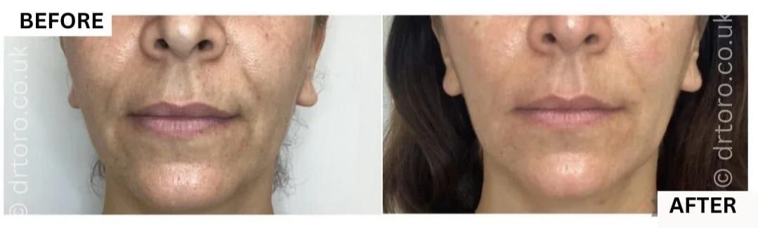 Before and after mid and lower face rejuvenation with dermal filler