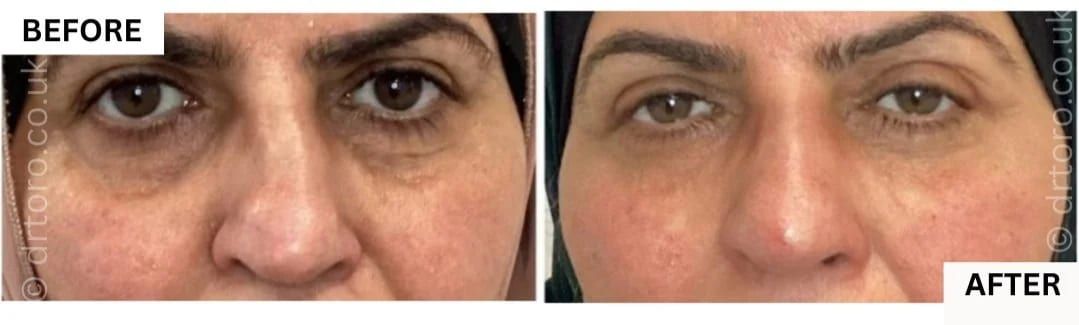 Before and after non-surgical rhinoplasty with dermal filler, improving nasal symmetry