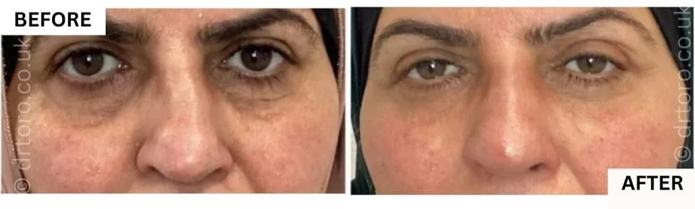 Before and after non-surgical rhinoplasty with dermal filler, improving nasal symmetry