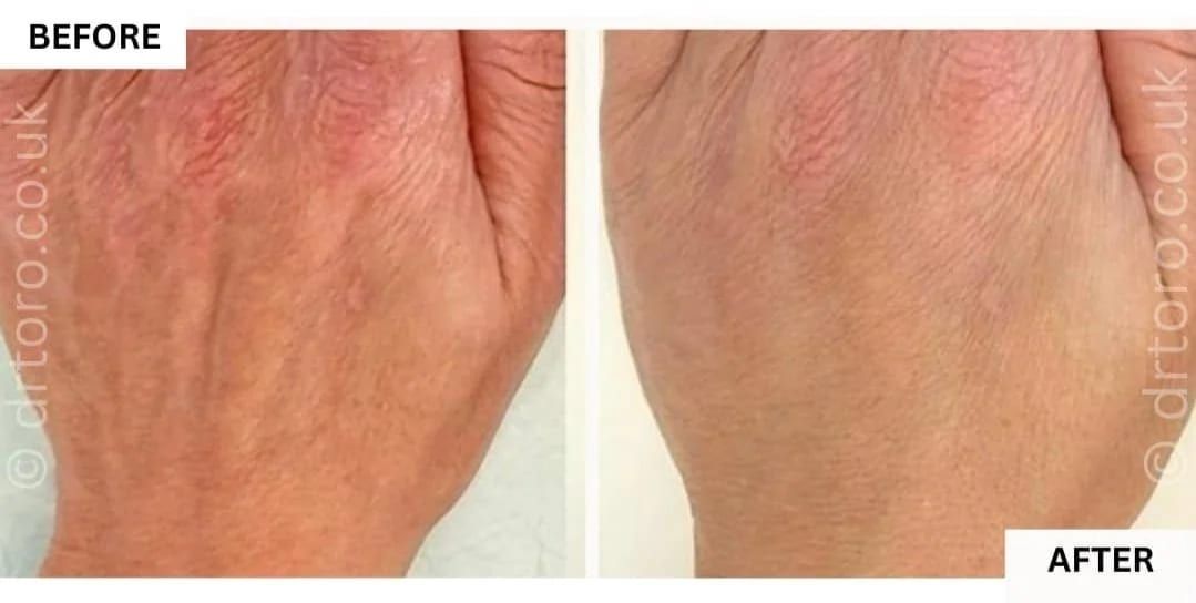 Before and after hand rejuvenation with Profhilo