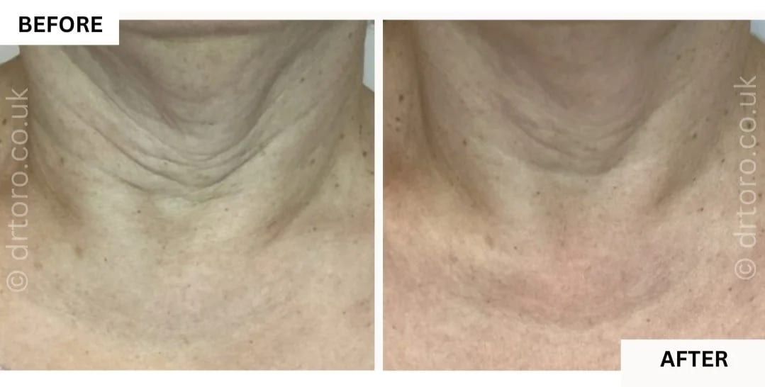 Before and after neck rejuvenation with Profhilo