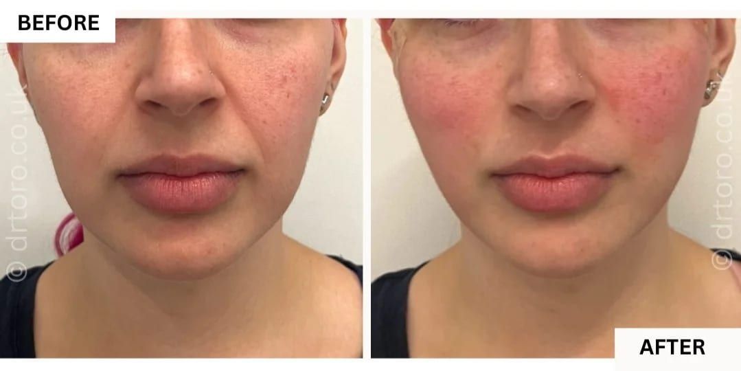 Before and after a PDO thread lift treating smile lines and jowls