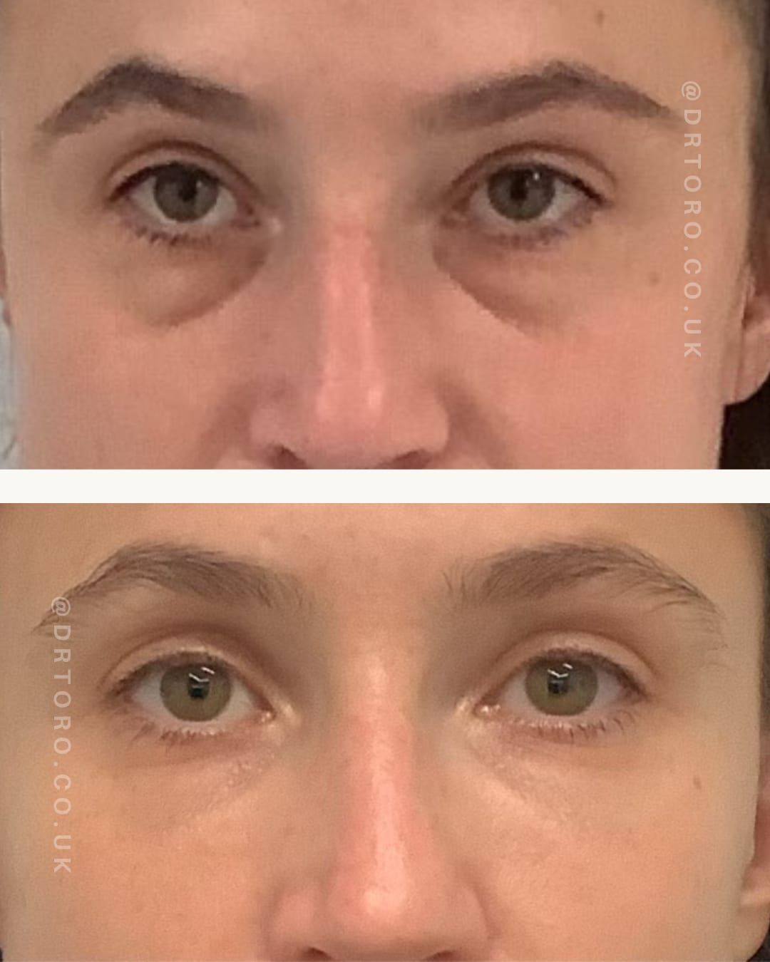 Before and after under-eye rejuvenation, reducing hollowing and shadow