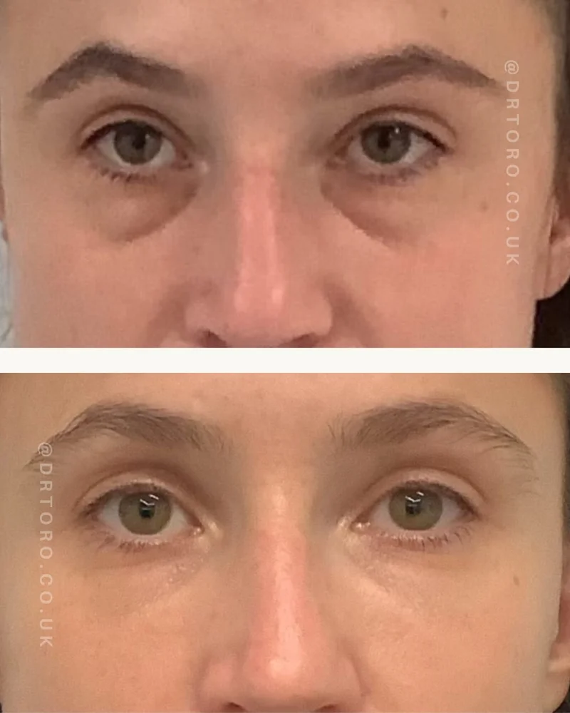 Before and after under-eye rejuvenation, reducing hollowing and shadow