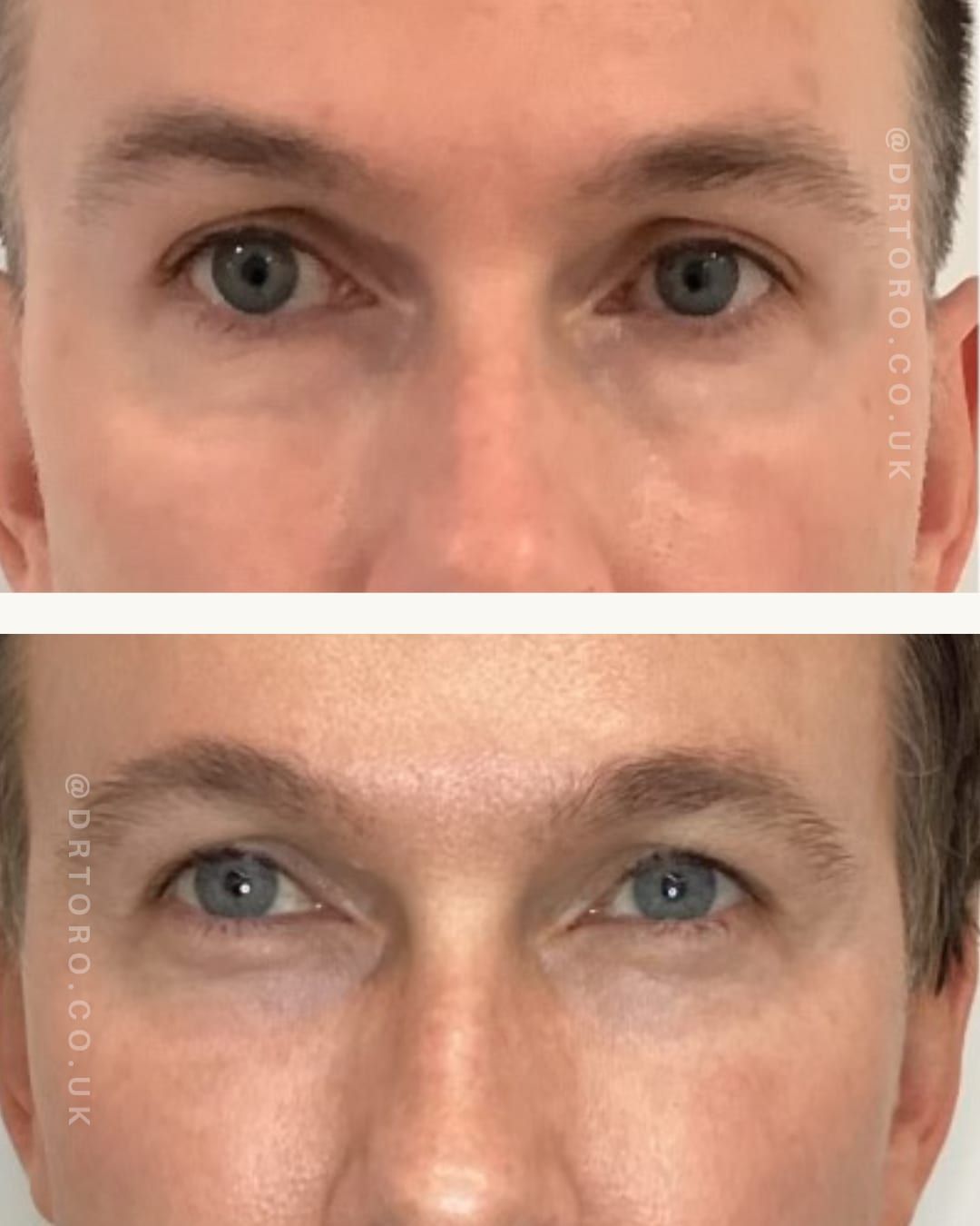 Before and after under-eye rejuvenation on a male patient
