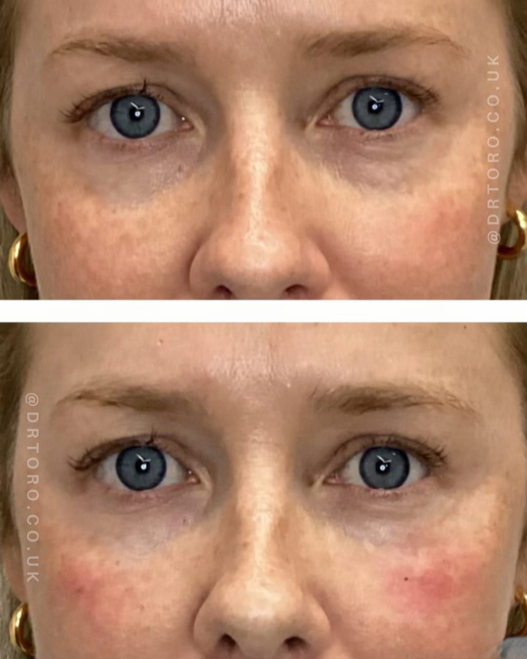 Before and after under-eye rejuvenation, softening the tear trough