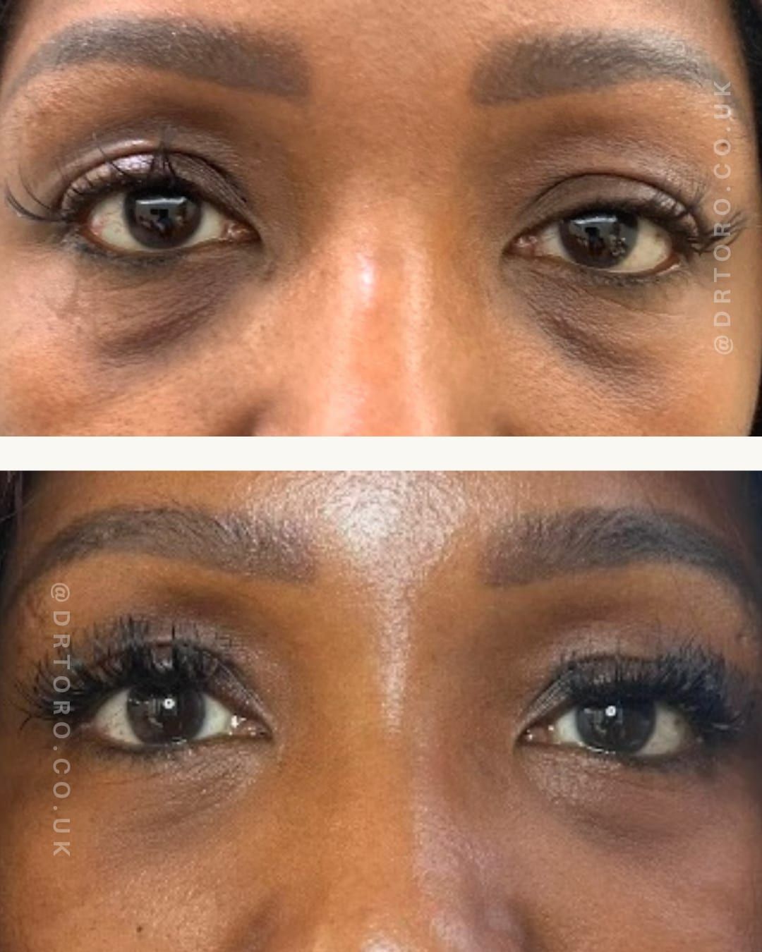 Before and after under-eye rejuvenation, brightening the under-eye area
