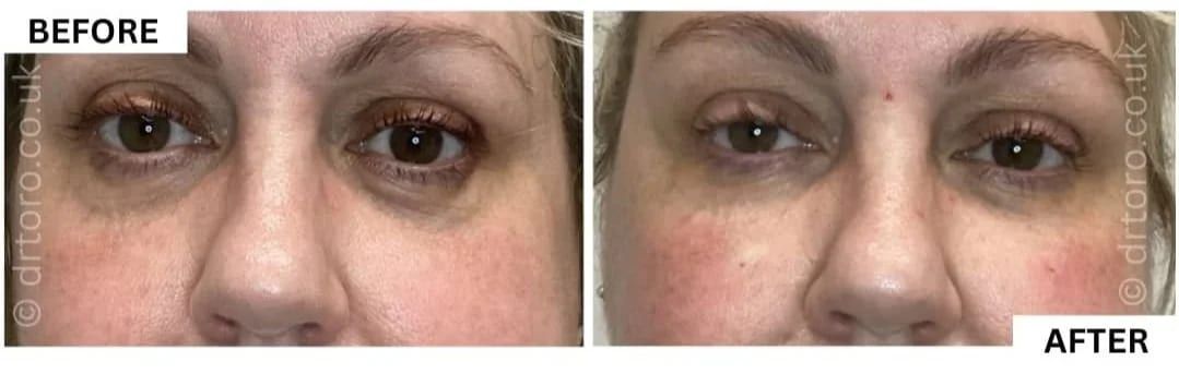 Before and after tear trough filler, reducing the under-eye hollow