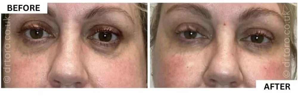 Before and after tear trough filler, reducing the under-eye hollow