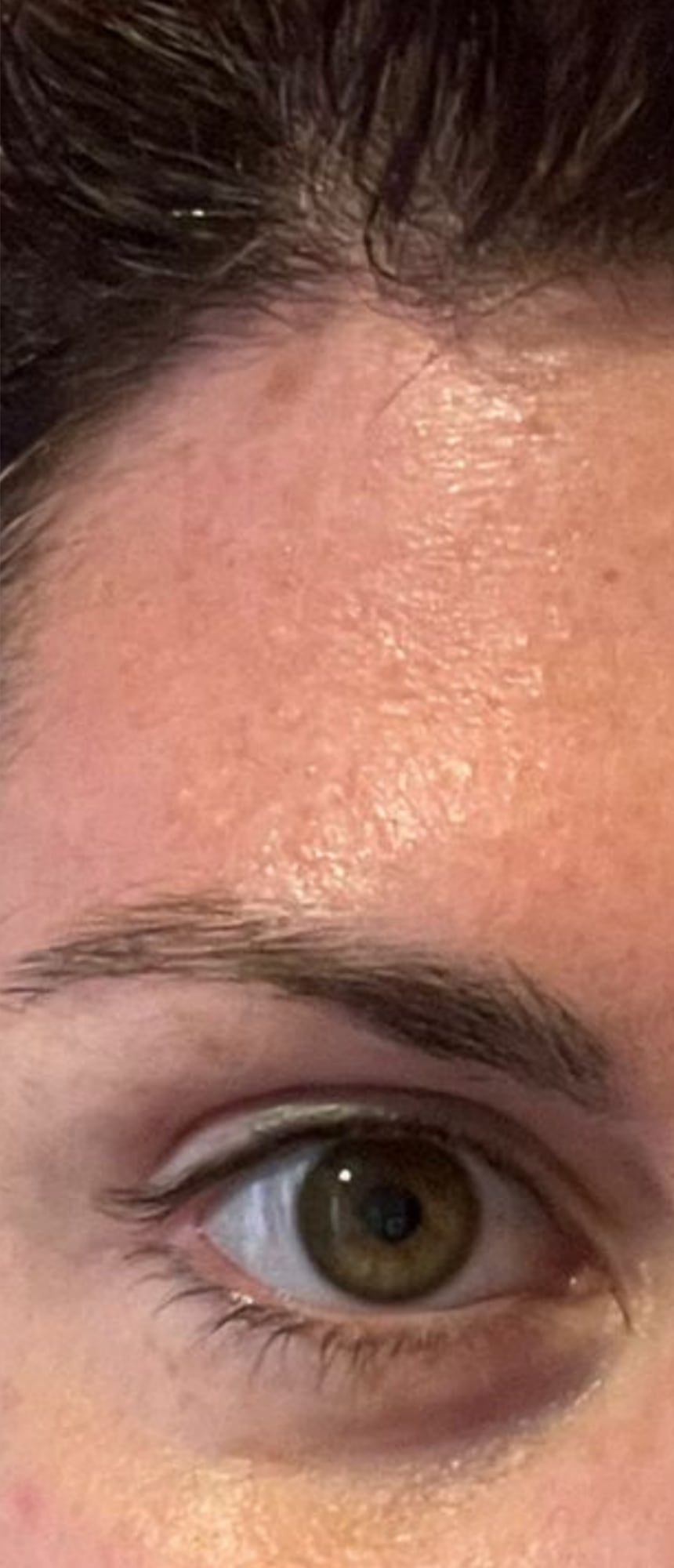 Forehead lines before and after anti-wrinkle treatment at Perfectus Derma Aesthetics