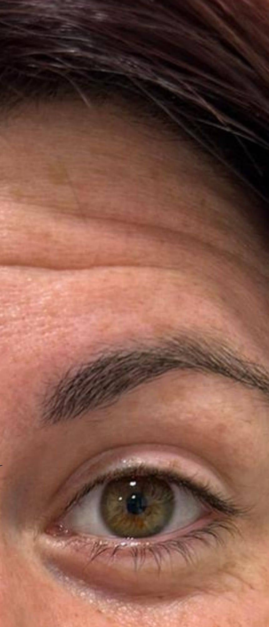 Forehead lines before and after anti-wrinkle treatment at Perfectus Derma Aesthetics