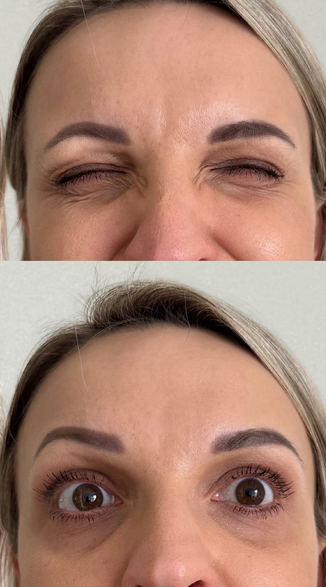 Frown and forehead lines before and after anti-wrinkle treatment at Perfectus Derma Aesthetics