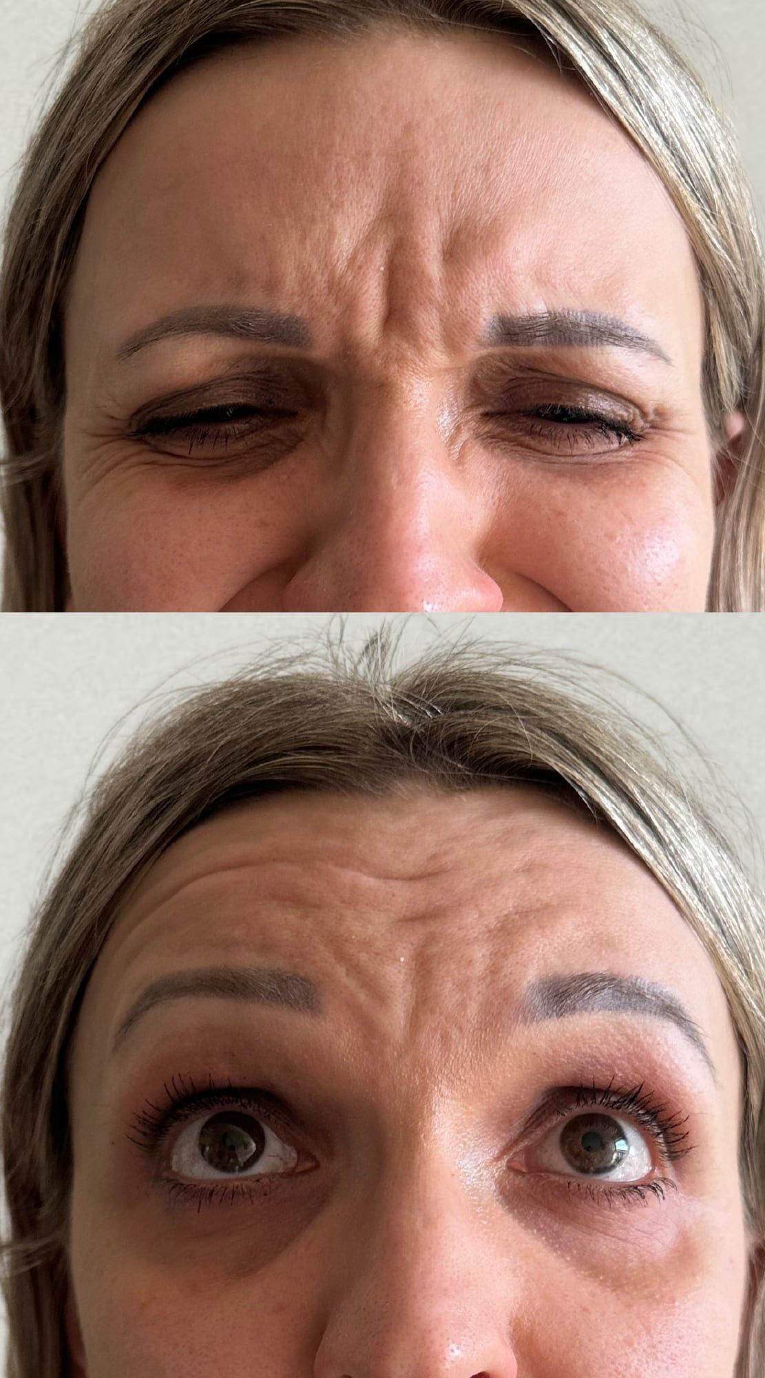 Frown and forehead lines before and after anti-wrinkle treatment at Perfectus Derma Aesthetics