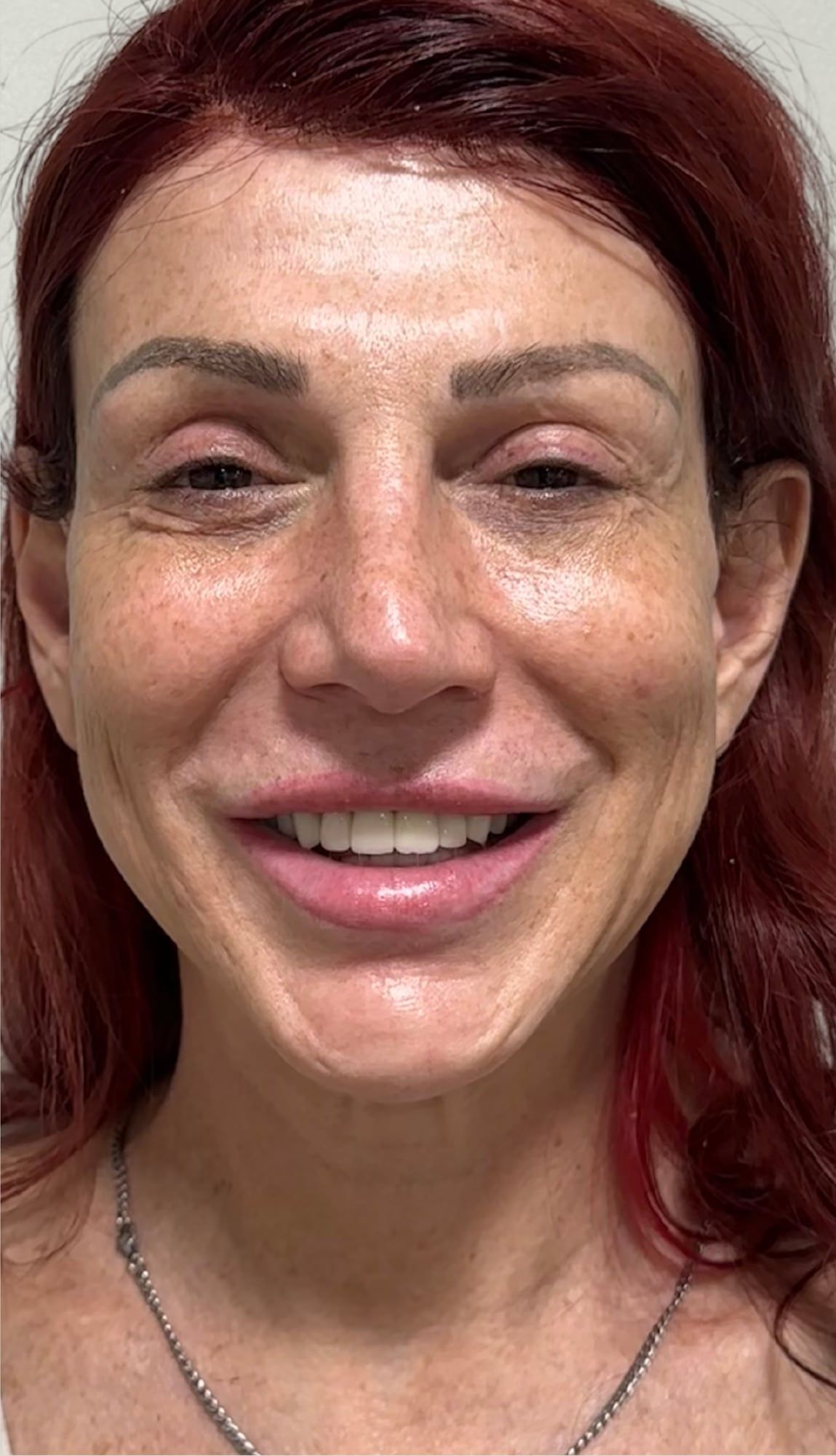 Full face before and after a combined dermal filler, polynucleotide, exosome and SkinPen plan at Perfectus Derma Aesthetics