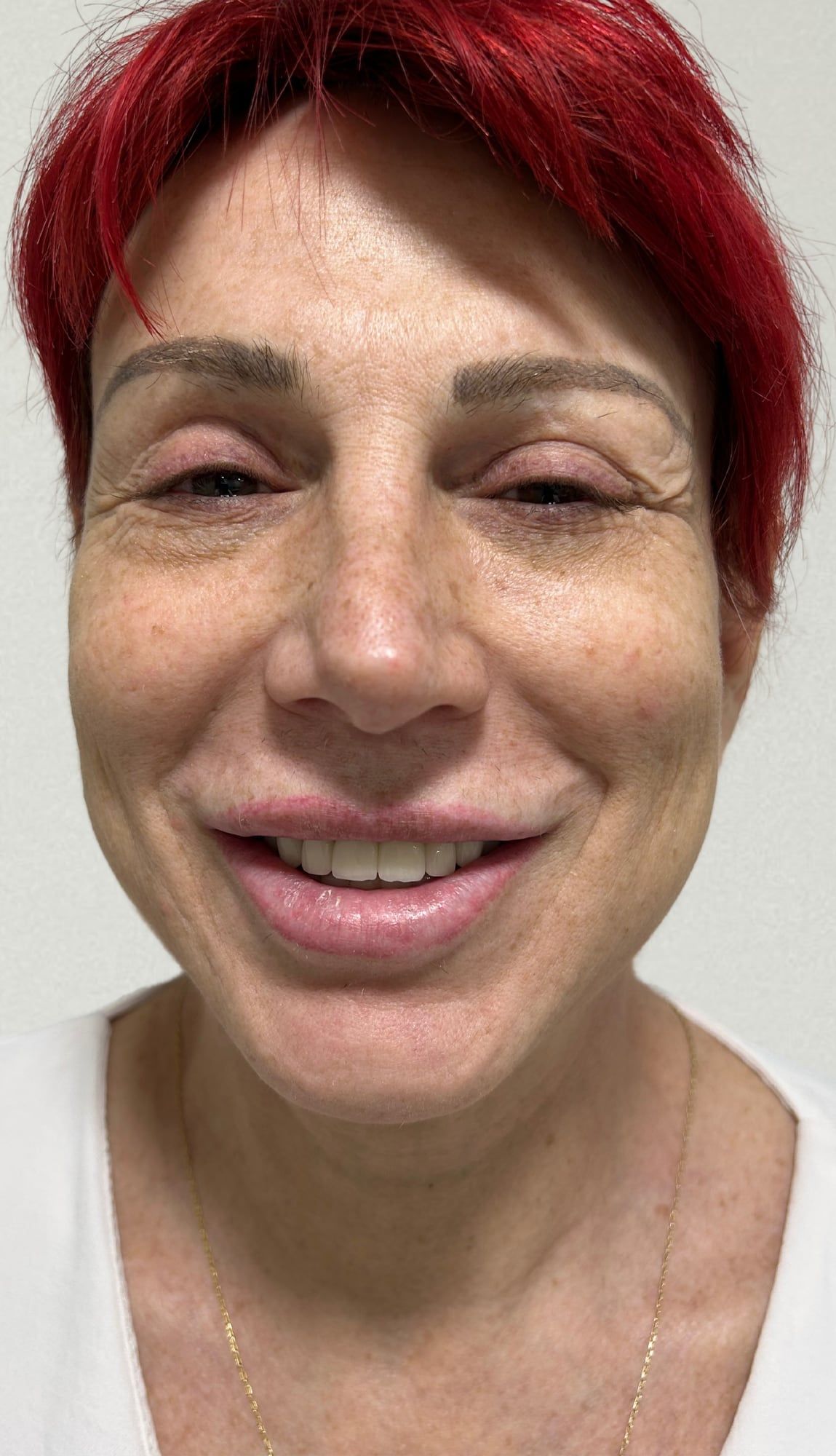 Full face before and after a combined dermal filler, polynucleotide, exosome and SkinPen plan at Perfectus Derma Aesthetics