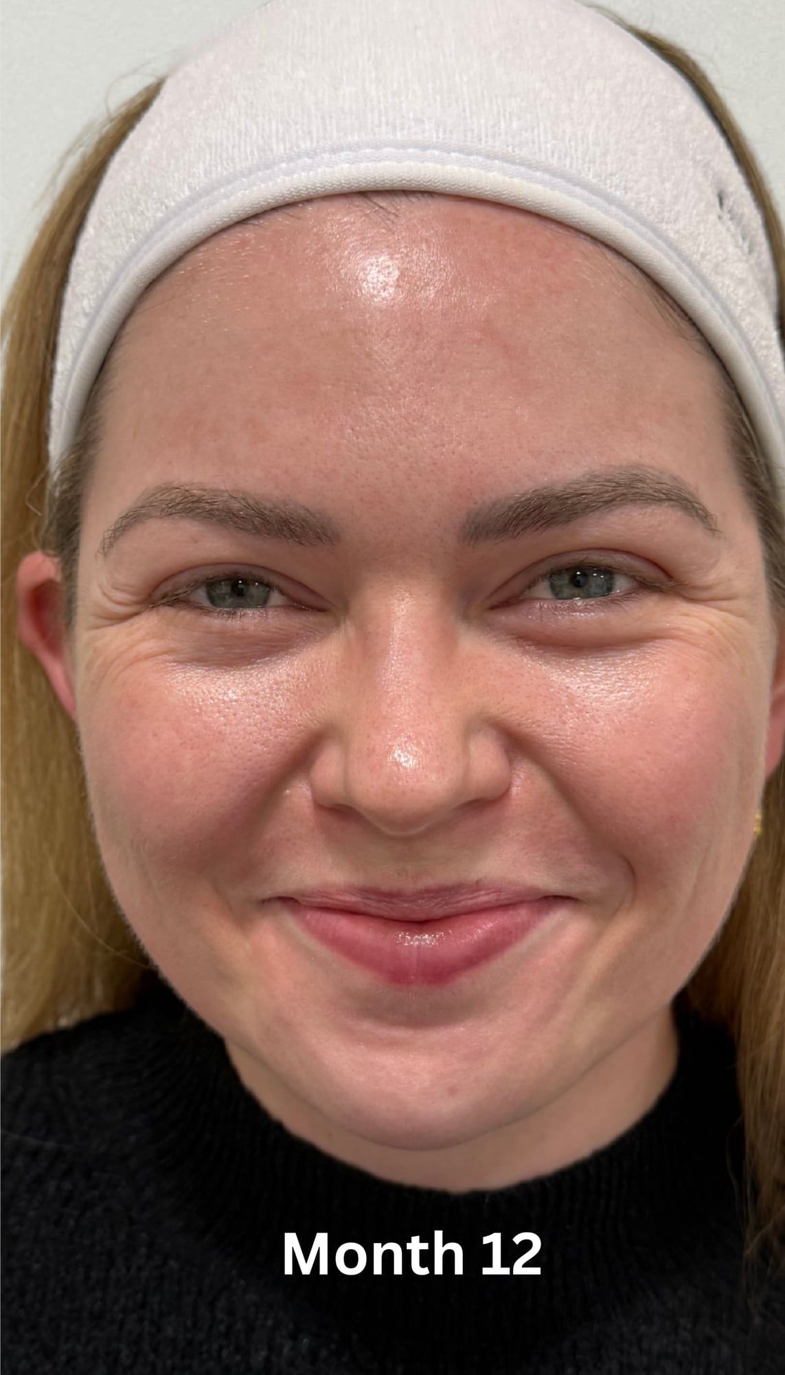Facial skin before and after a combined course of SkinPen microneedling, exosome therapy, chemical peels and science-based skincare at Perfectus Derma Aesthetics — after