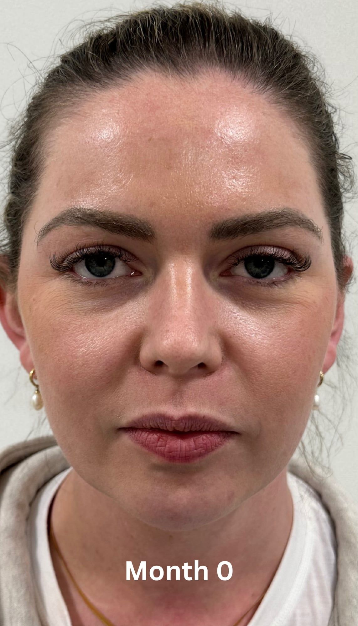 Facial skin before and after a combined course of SkinPen microneedling, exosome therapy, chemical peels and science-based skincare at Perfectus Derma Aesthetics — before