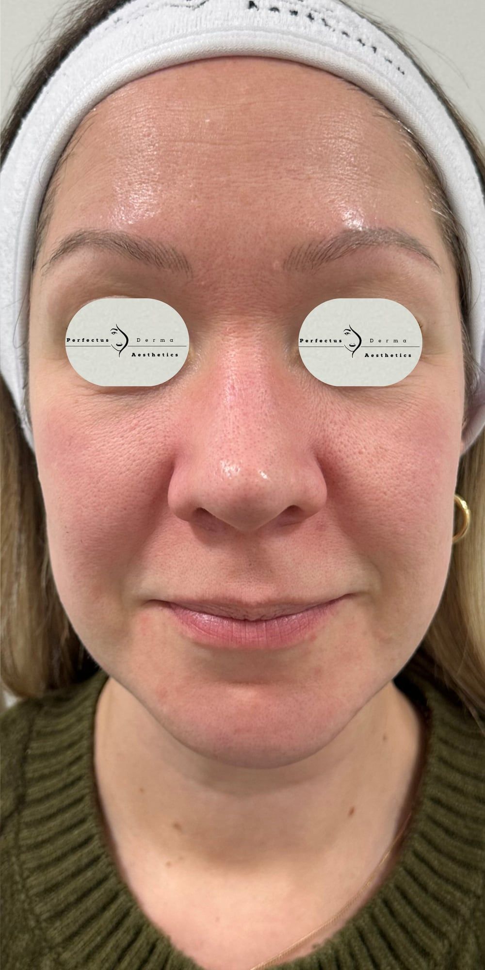 Facial redness and texture before and after a combined course of science-based skincare, SkinPen microneedling and exosome therapy at Perfectus Derma Aesthetics — after