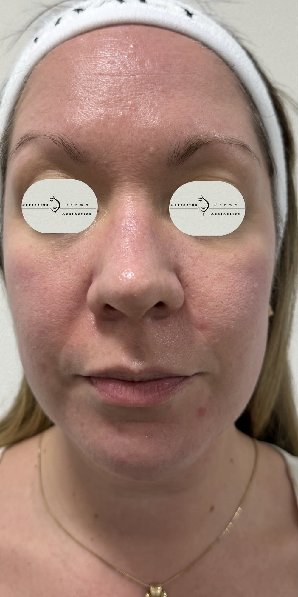 Facial redness and texture before and after a combined course of science-based skincare, SkinPen microneedling and exosome therapy at Perfectus Derma Aesthetics — before