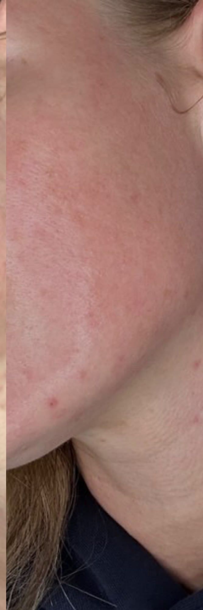 Acne-prone skin before and after a science-based skincare protocol at Perfectus Derma Aesthetics