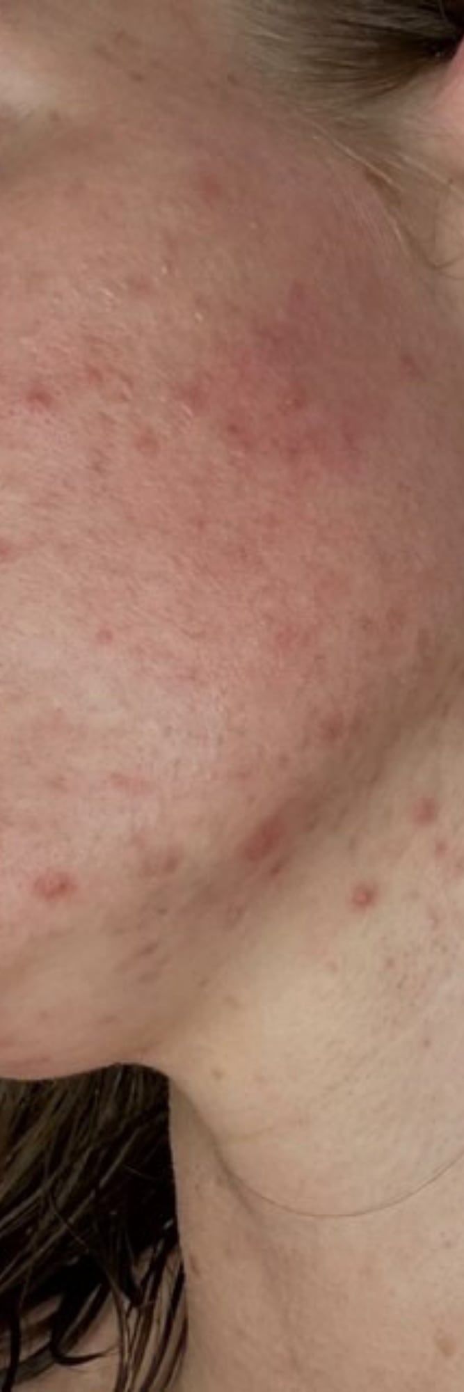 Acne-prone skin before and after a science-based skincare protocol at Perfectus Derma Aesthetics