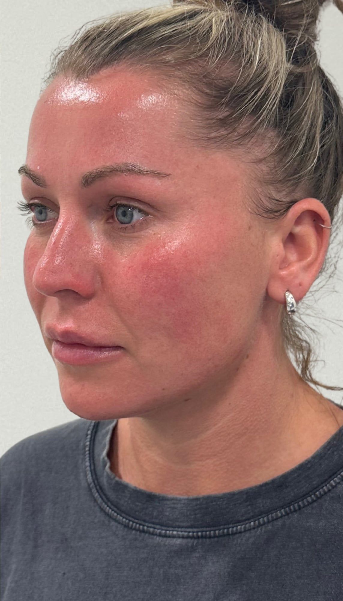 Mid and lower face before and after dermal filler contouring at Perfectus Derma Aesthetics