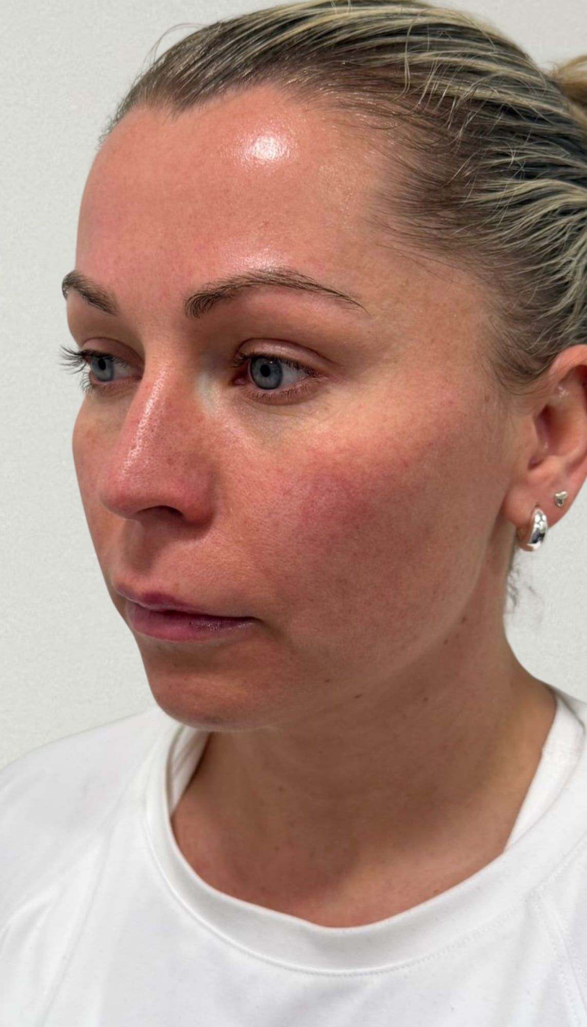 Mid and lower face before and after dermal filler contouring at Perfectus Derma Aesthetics