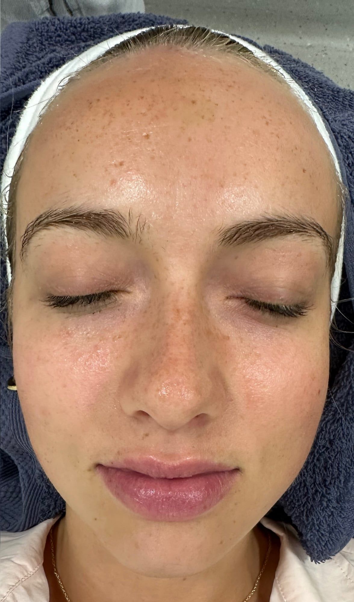 Skin radiance before and after a Hydro2Facial at Perfectus Derma Aesthetics