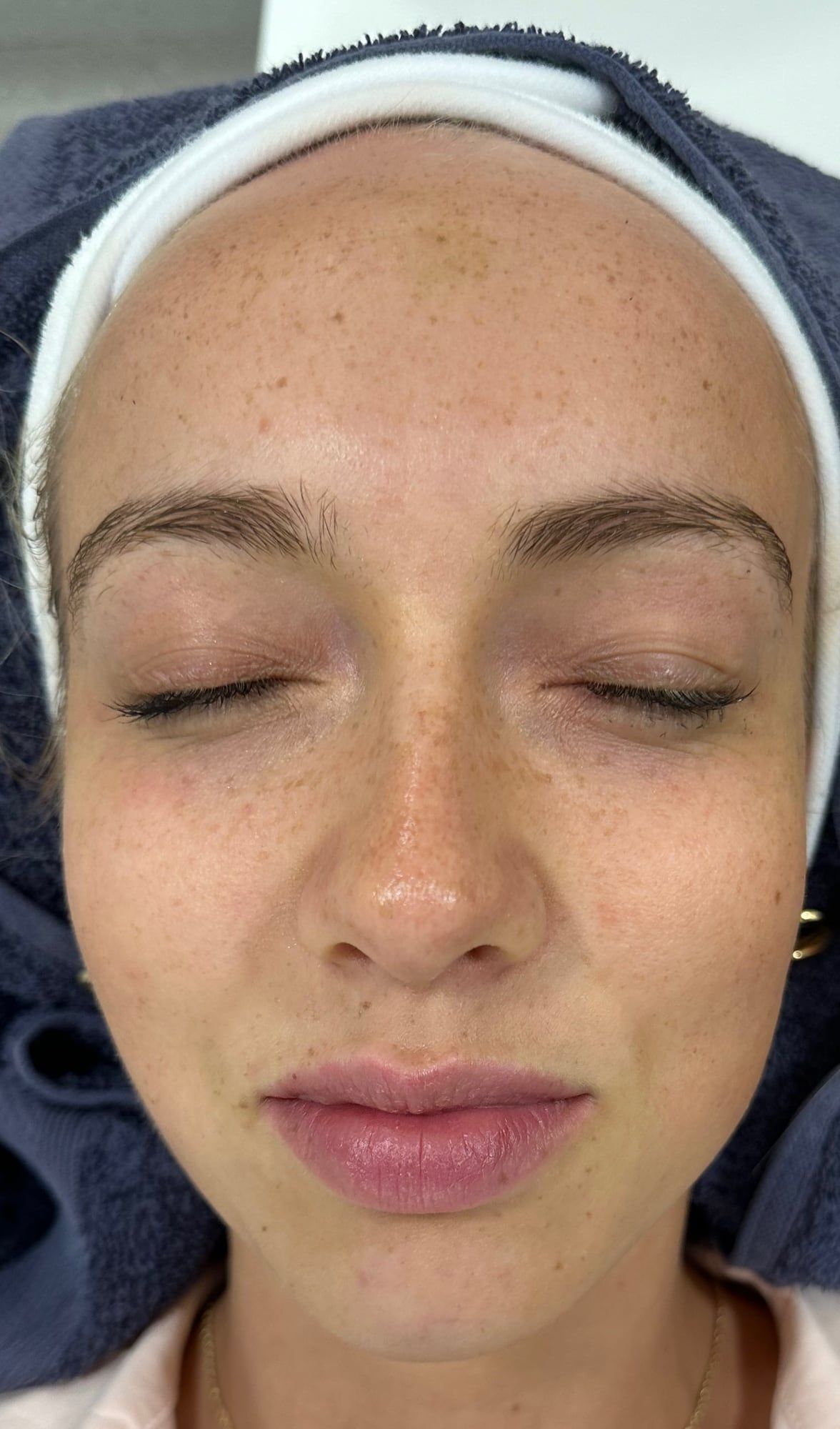 Skin radiance before and after a Hydro2Facial at Perfectus Derma Aesthetics