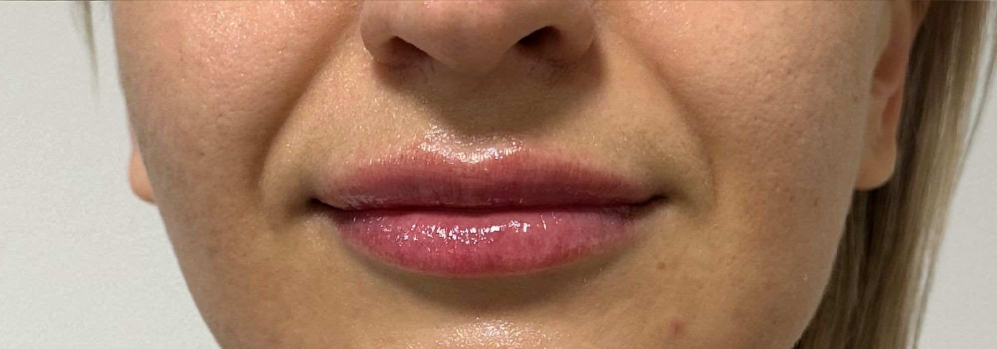 Lips before and after dermal filler treatment at Perfectus Derma Aesthetics