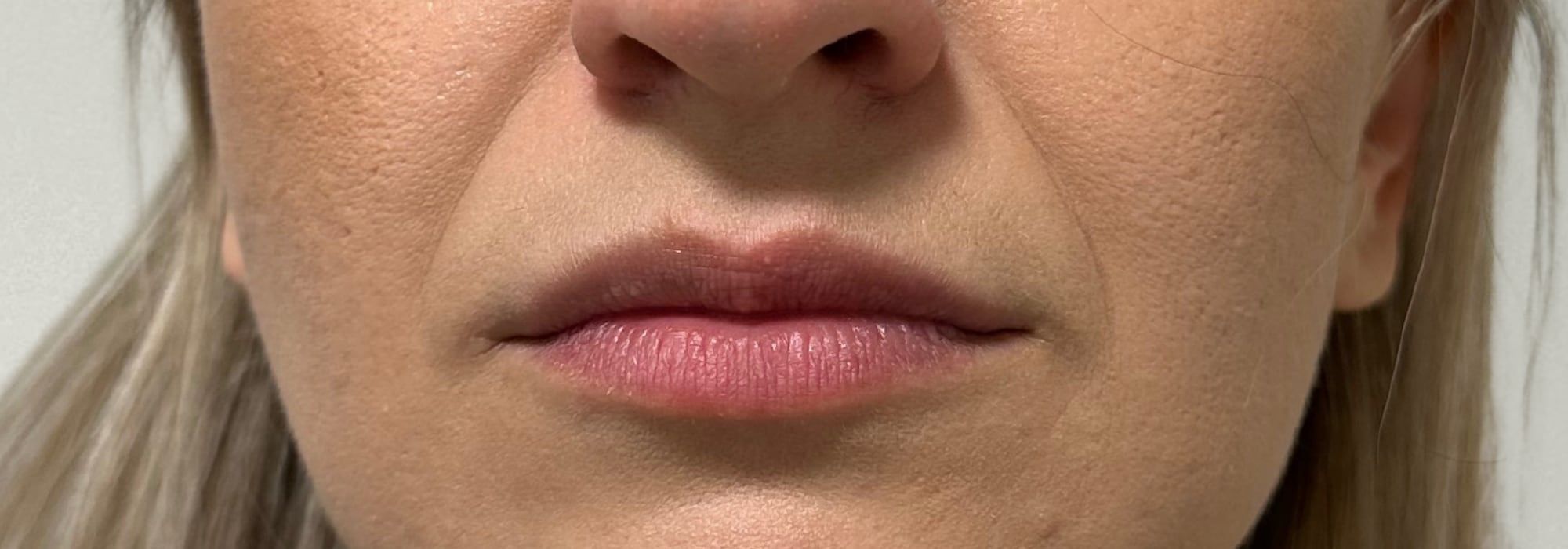 Lips before and after dermal filler treatment at Perfectus Derma Aesthetics