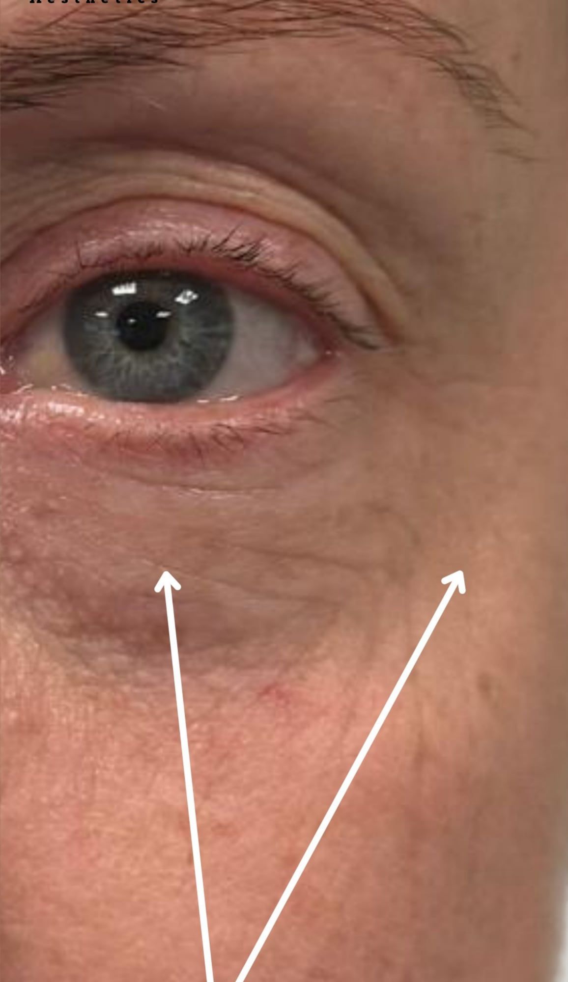 Under-eye area before and after polynucleotide treatment at Perfectus Derma Aesthetics