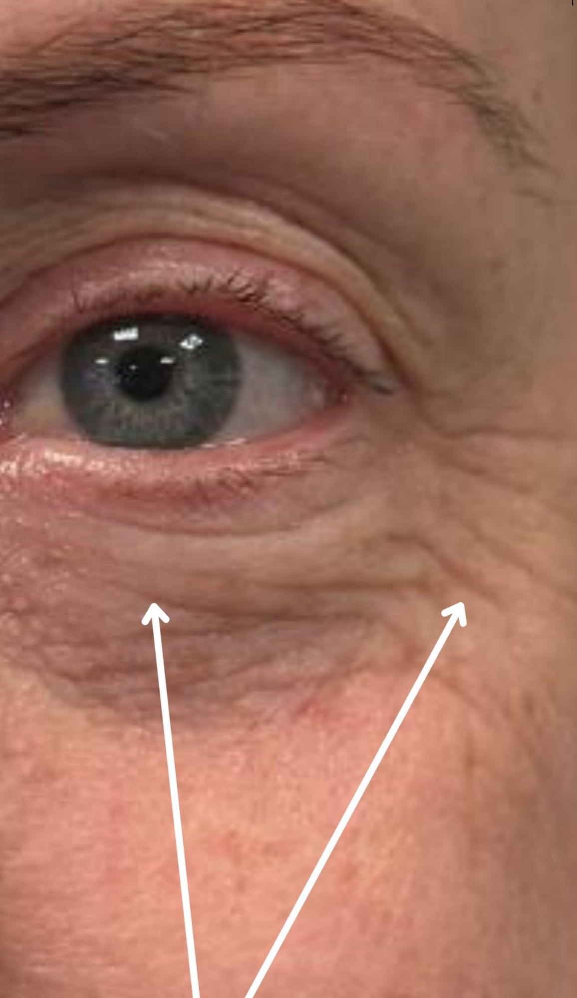 Under-eye area before and after polynucleotide treatment at Perfectus Derma Aesthetics