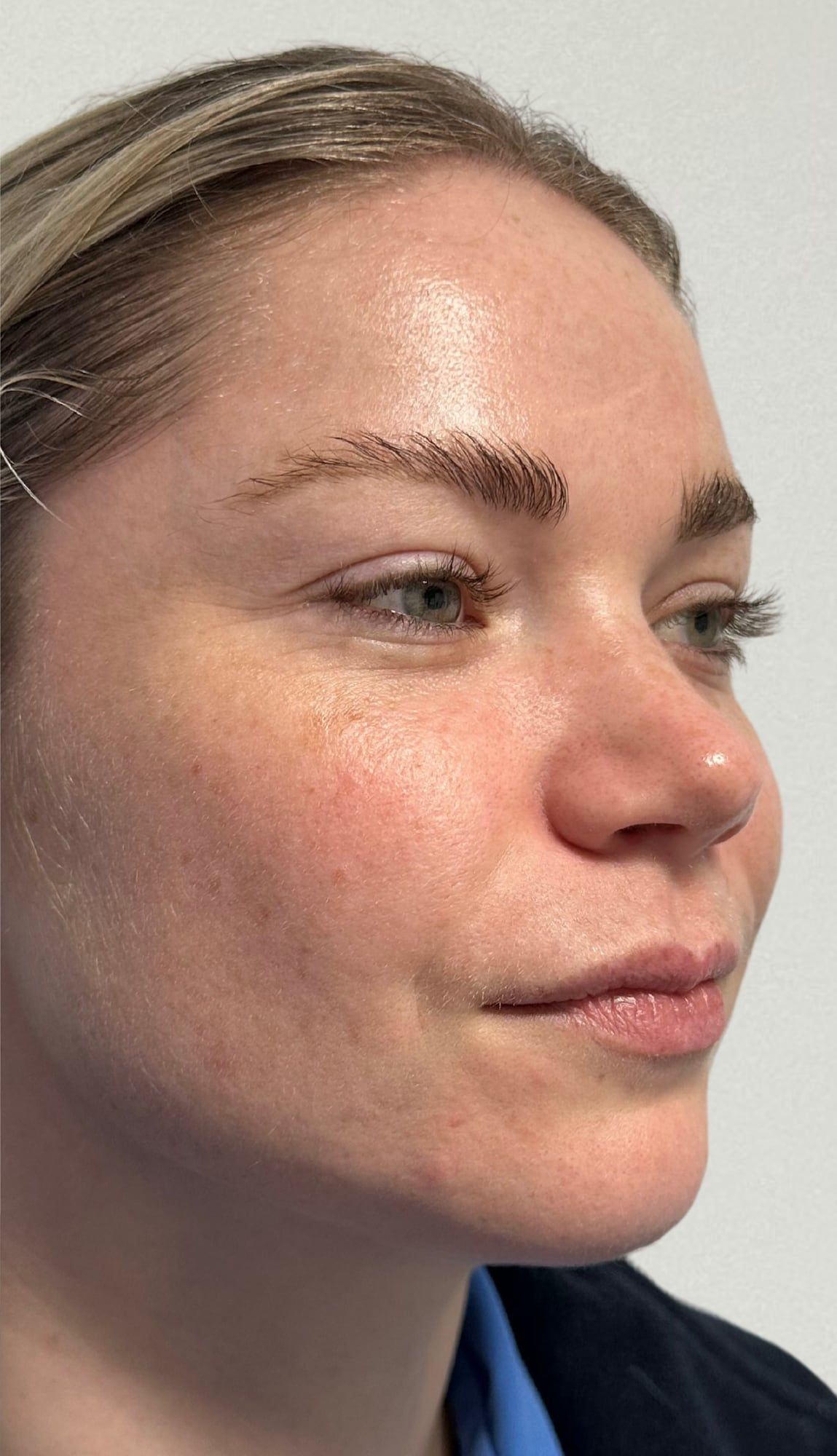 Facial skin quality before and after skin booster treatment at Perfectus Derma Aesthetics