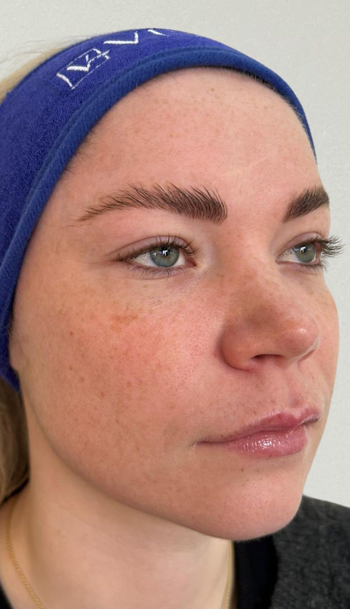 Facial skin quality before and after skin booster treatment at Perfectus Derma Aesthetics