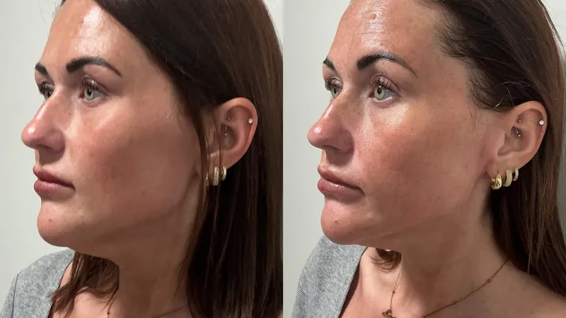 Facial Volume Loss