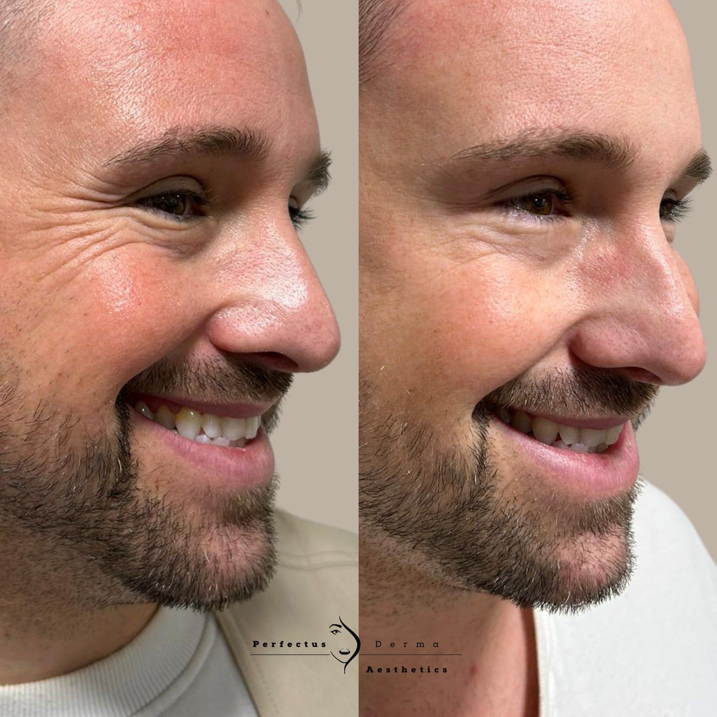 A patient in profile before and after anti-wrinkle treatment at Perfectus Derma Aesthetics