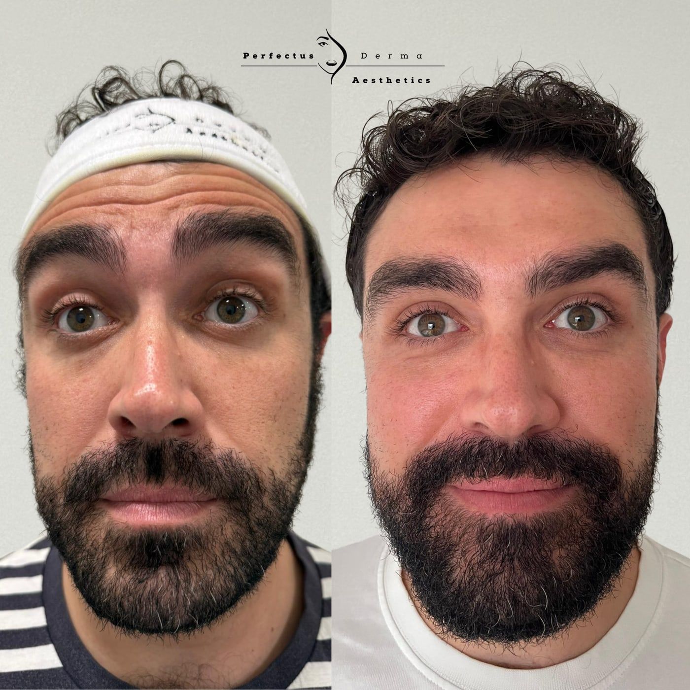 Forehead before and after anti-wrinkle treatment at Perfectus Derma Aesthetics