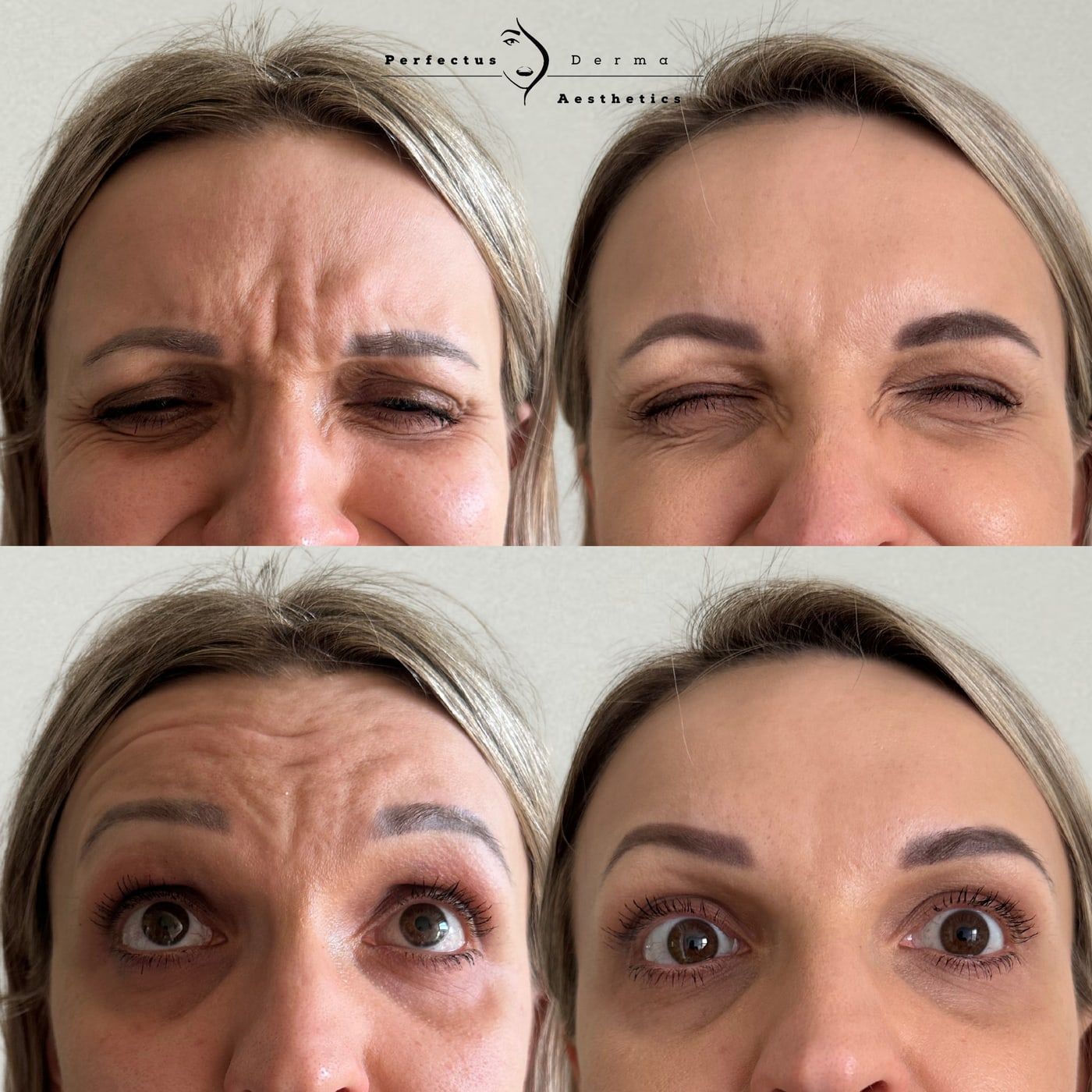 Forehead and frown lines before and after anti-wrinkle treatment at Perfectus Derma Aesthetics, shown frowning and with the brows raised