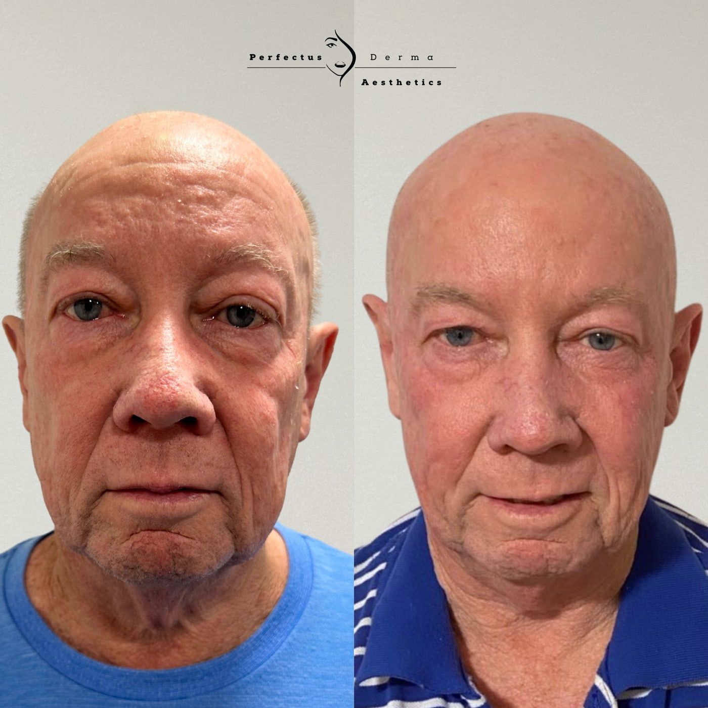 A patient before and after a combination plan of anti-wrinkle treatment, polynucleotides and SkinPen microneedling at Perfectus Derma Aesthetics